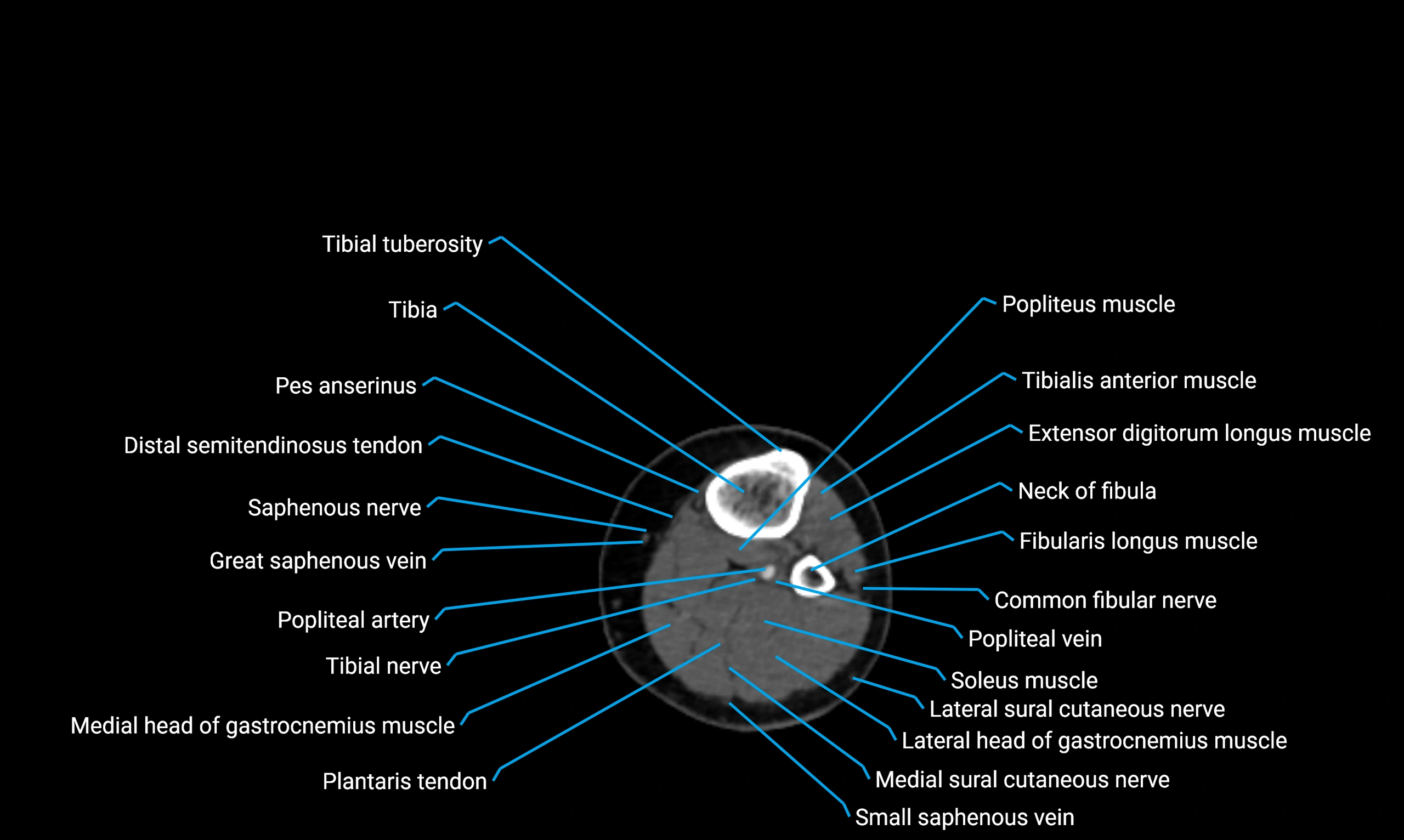 CT lower limb axial cross sectional anatomy labelled image 100 (2).webp